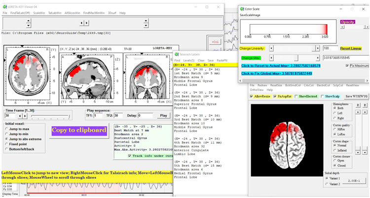 Figure 22 - Post-neurofeedback eyes-closed z-score LORETA analysis for 30 Hz
